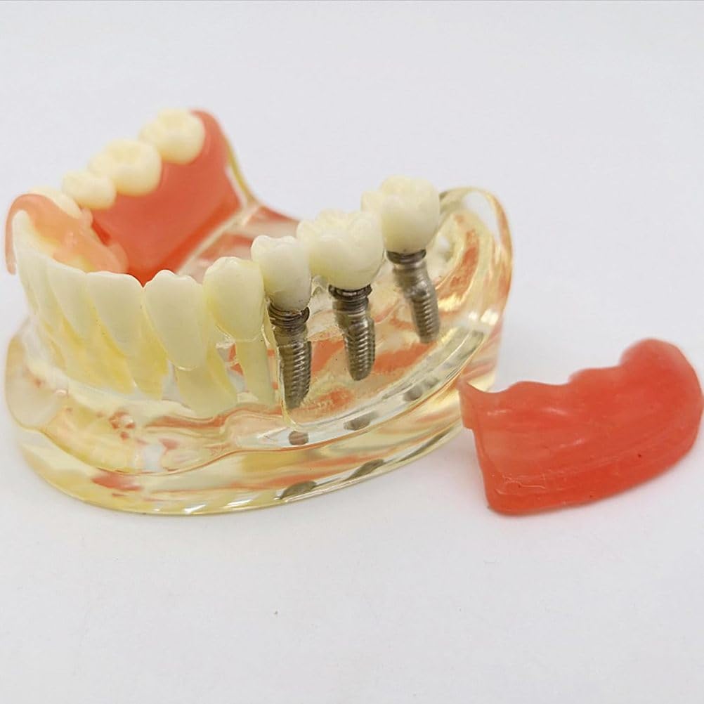 Implant-Supported Restorations Comparison Model Transparent Dental Implant Model Education Study