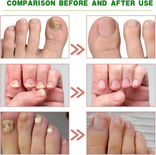 Opiniones y reviews de Desenterrador de uñas Top 5. 30 Imagen adicional