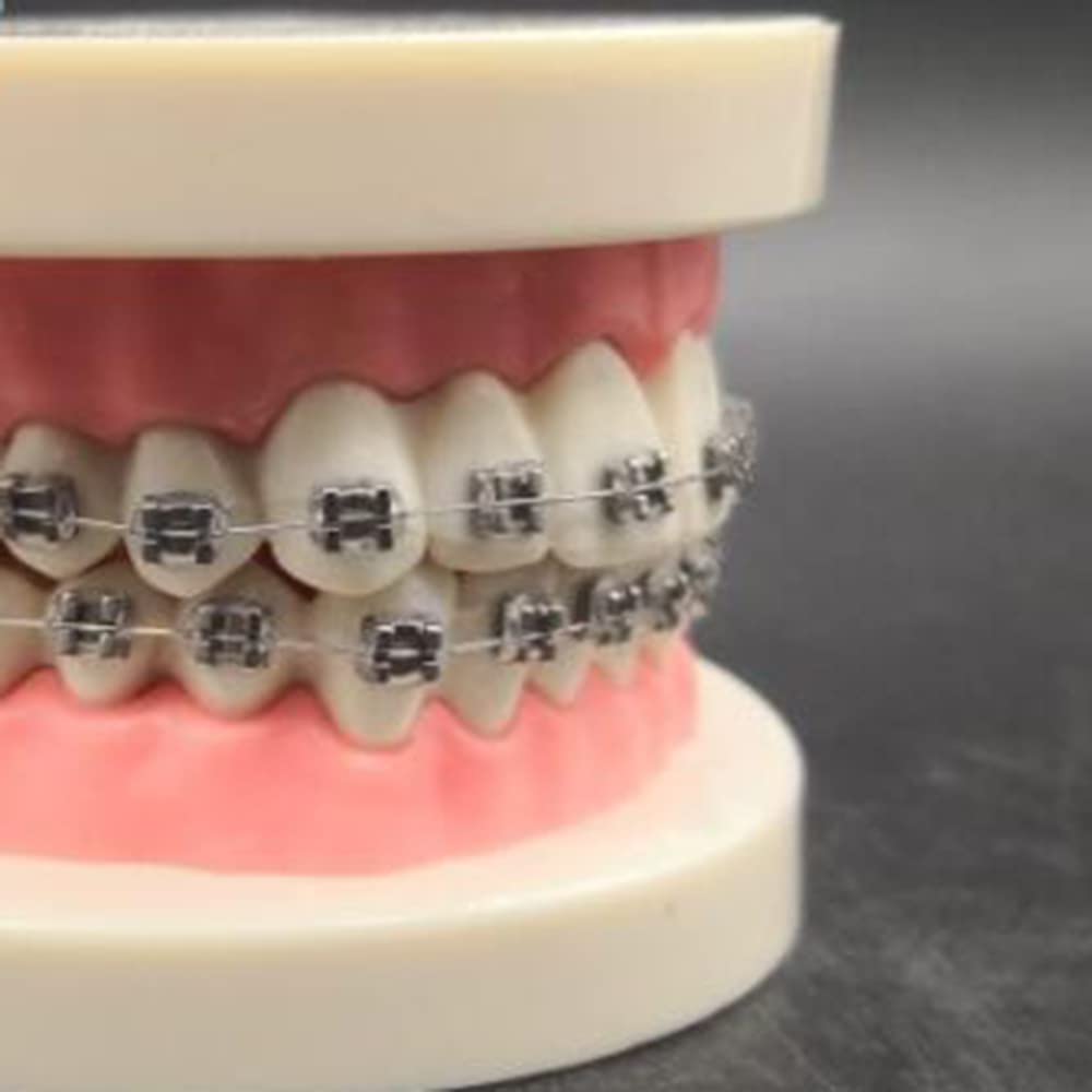 Modello di Simulazione dei Denti orali - Modello dimostrativo ortodontico Dentale - Modello di Trattamento dei Denti dentali con Attacco Metallico, Modello esplicativo dell'ar,B
