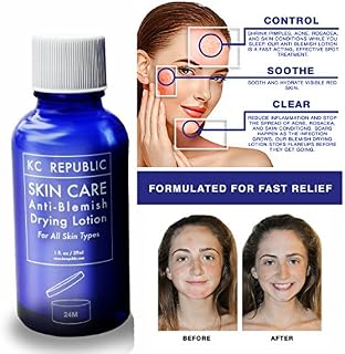 Acne Drying Lotion with Salicylic Acid & Calamine - Clears Pimples, Teen Acne