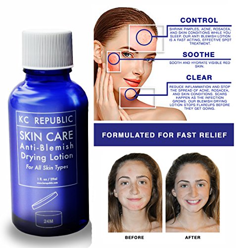 calamine drying lotion