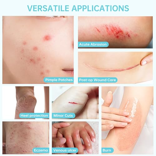 Image of Hydrocolloid Roll, Medical Grade Hydrocolloid Dressing Roll for Wound Care, Hydrocolloid Tape for Blisters and Acne Treatment, Waterproof Cut-to-Fit Bandage, 5 cm x 1.5 Meter Roll