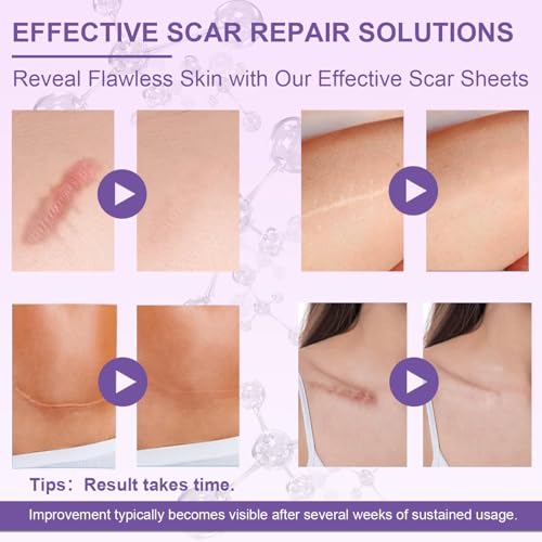Image of Silicone Scar Sheets, Advanced Medical Silicone Scar Tape(1.6 inchx 60 inchRoll-1.5M), Professional Grade Scar Removal Strip for Surgery, Tummy, Mouth, Face, C Section, Burn, Keloid, Acne Scars etc