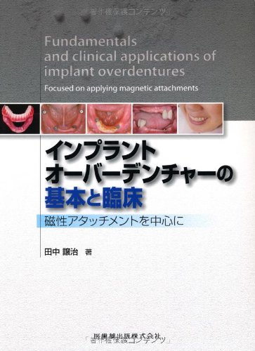 インプラントオーバーデンチャーの基本と臨床磁性アタッチメント