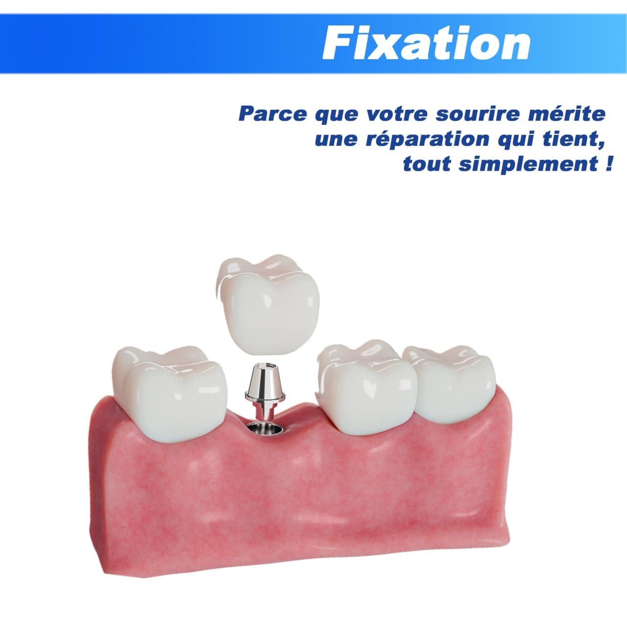 Kit de Réparation Dentaire –pansement dentaire - Solution Facile et Durable pour Couronnes, Ponts et Obturations – Garantie Satisfaction