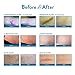 Aroamas Professional Silicone Scar Removal Sheets for Scars Caused by C-Section, Surgery, Burn, Keloid, Acne, and more, Soft Adhesive Fabric Strips, Drug-Free, 5.7