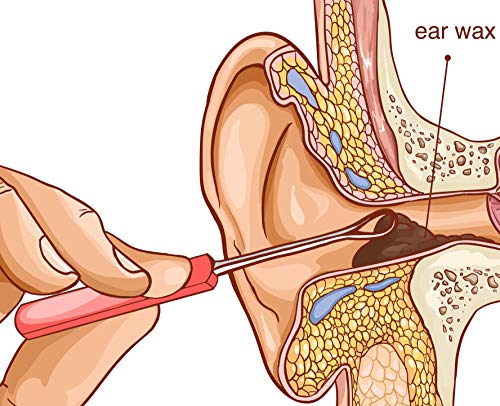 REMOS Ohrreiniger zum hygienischen Entfernen von Ohrenschmalz Länge 6.5 cm