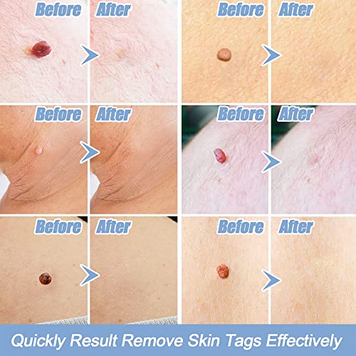 Mingzhe Caneta para remover marcas de pele Cuidados faciais Ferramenta de nevo 2mm-4mm Remover nevo