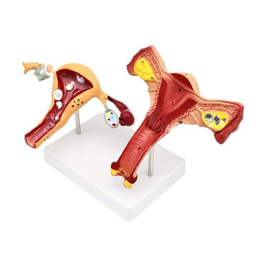 DBSCD Uterine Model - Uterine Pathological And Ovary Model - Anatomical Human Ovarian Vaginal Disease for Teaching, Cross Section Study Tool