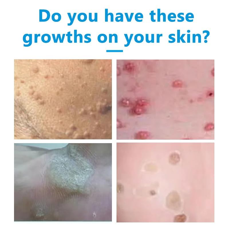 Crema eliminadora de verrugas 20g, eficaz para congelar verrugas, plantas de los pies, verrugas comunes, verrugas planas, callos, durezas, apta para manos, pies y espalda