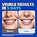 PERSMAX Teeth Whitening Strips – Professional Dentist Approved, Gum-Safe Formula, 28 Non-Slip Strips, 14 Treatment, Pain-Free Express Whitening Kit in 30 Min, Easy to Use for Bright Smile
