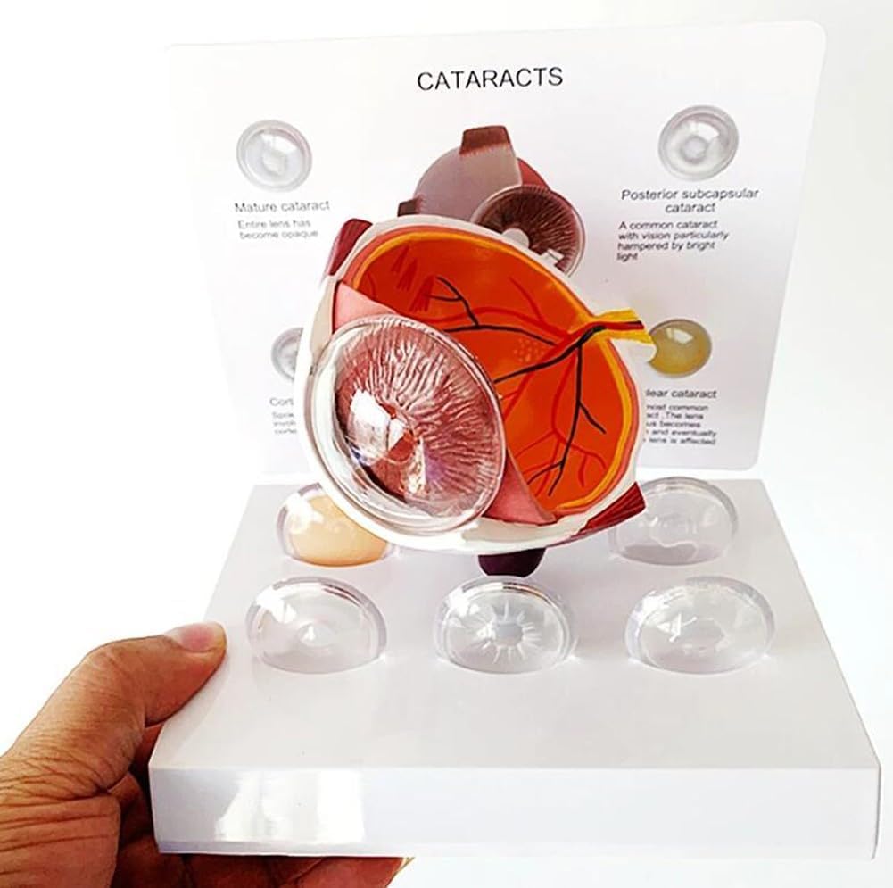 Modèle œil de cataracte pour éducation anatomique et apprentissage de la biologie