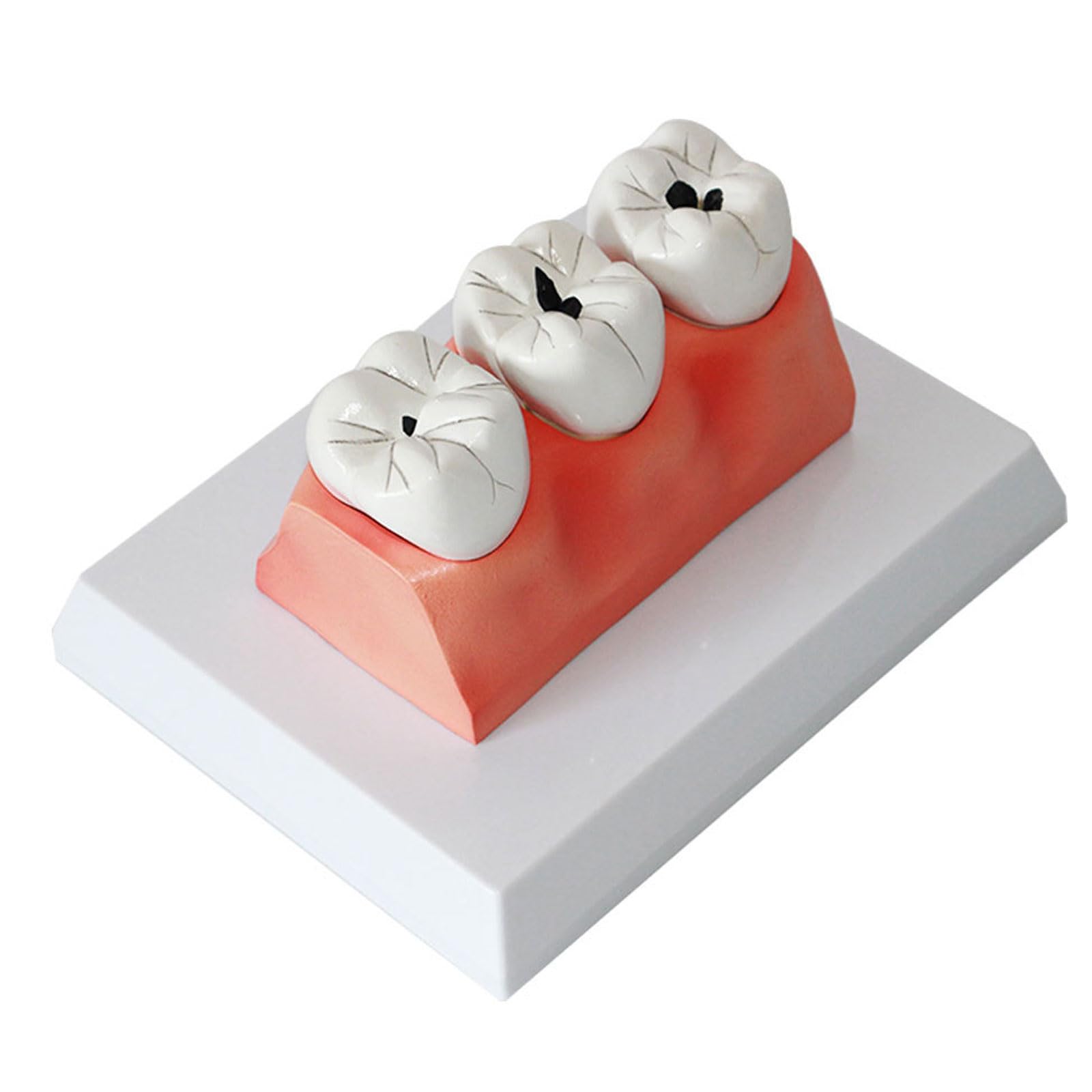 Modelli di comparazione della Carie 4 Volte Modello di decomposizione della Carie Denti sezionati Modello per la Ricerca didattica Modello di Studio per Studenti di odontoiatria