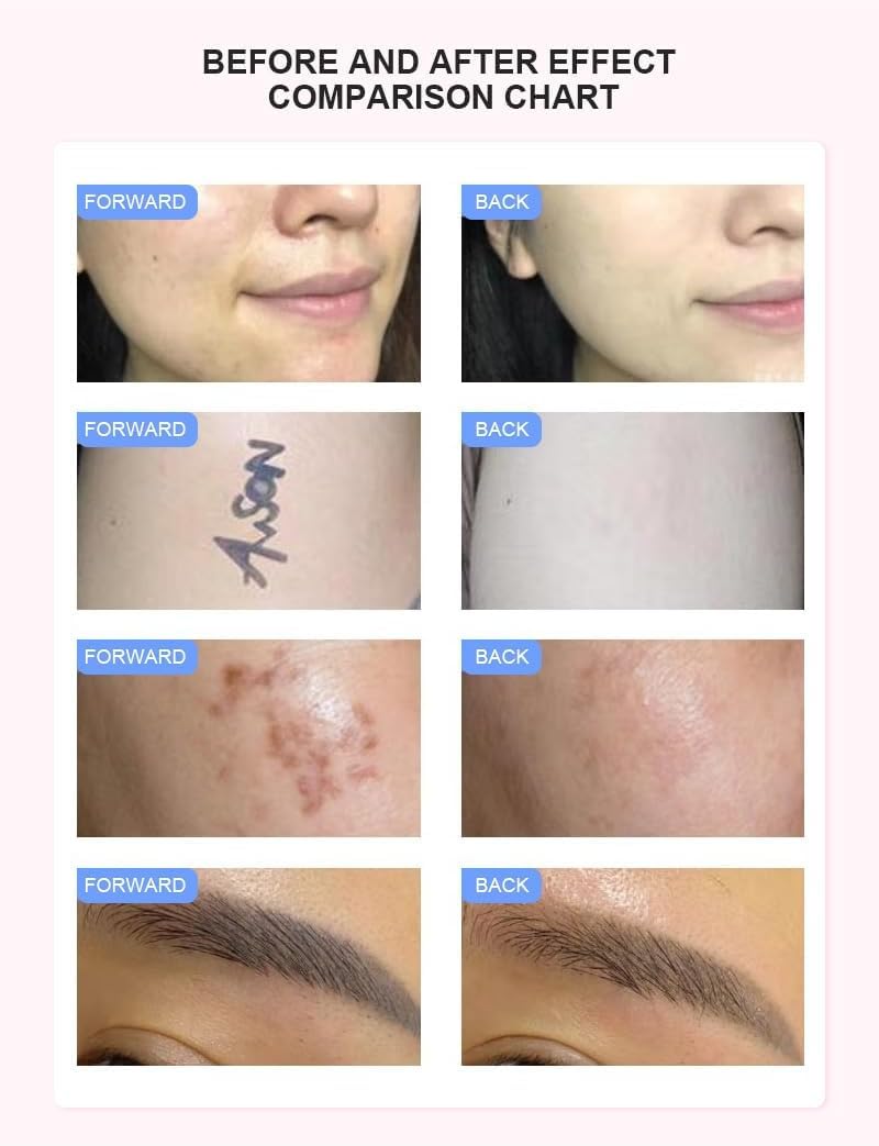 Máquina Para Depilación IPL Láser Congelado 2 en 1 OPT, Eliminación Láser de Tatuajes en Picosegundos Equipo Para el Cuidado de la piel