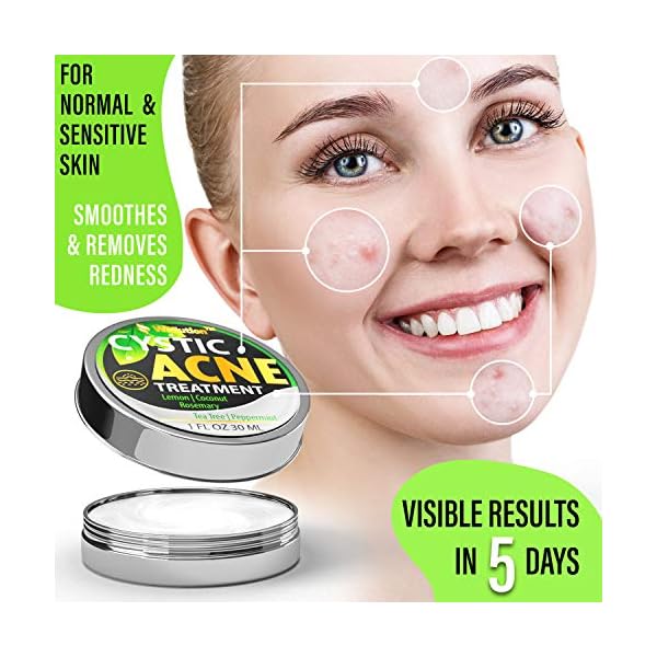 Cystic-Acne-Treatment-and-Acne-Scar-Remover-Made-in-USA-Effective-Face-Body-Severe-Acne-Cleanser-with-Tea-Tree-Oil-Prevent-Future-Breakouts-Natural-Acne-Spot-Pimple-Cream Wellution Cystic Acne Treatment Cream - Natural Pimple and Scar Remover with Tea Tree Oil - Effective Overnight Face Treatment for Acne Spots, Pimples and Scars - 1oz