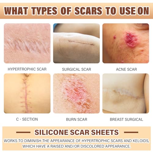 Psecici Silicone Scar Sheets,Silicone Scar Tape,Silicone Sheets For Scars,Scar Tape For Surgical Scars,Silicone Scar Removal Strips For C-Section,Tummy Tuck Scars Keloid Bump Removal thumb #4