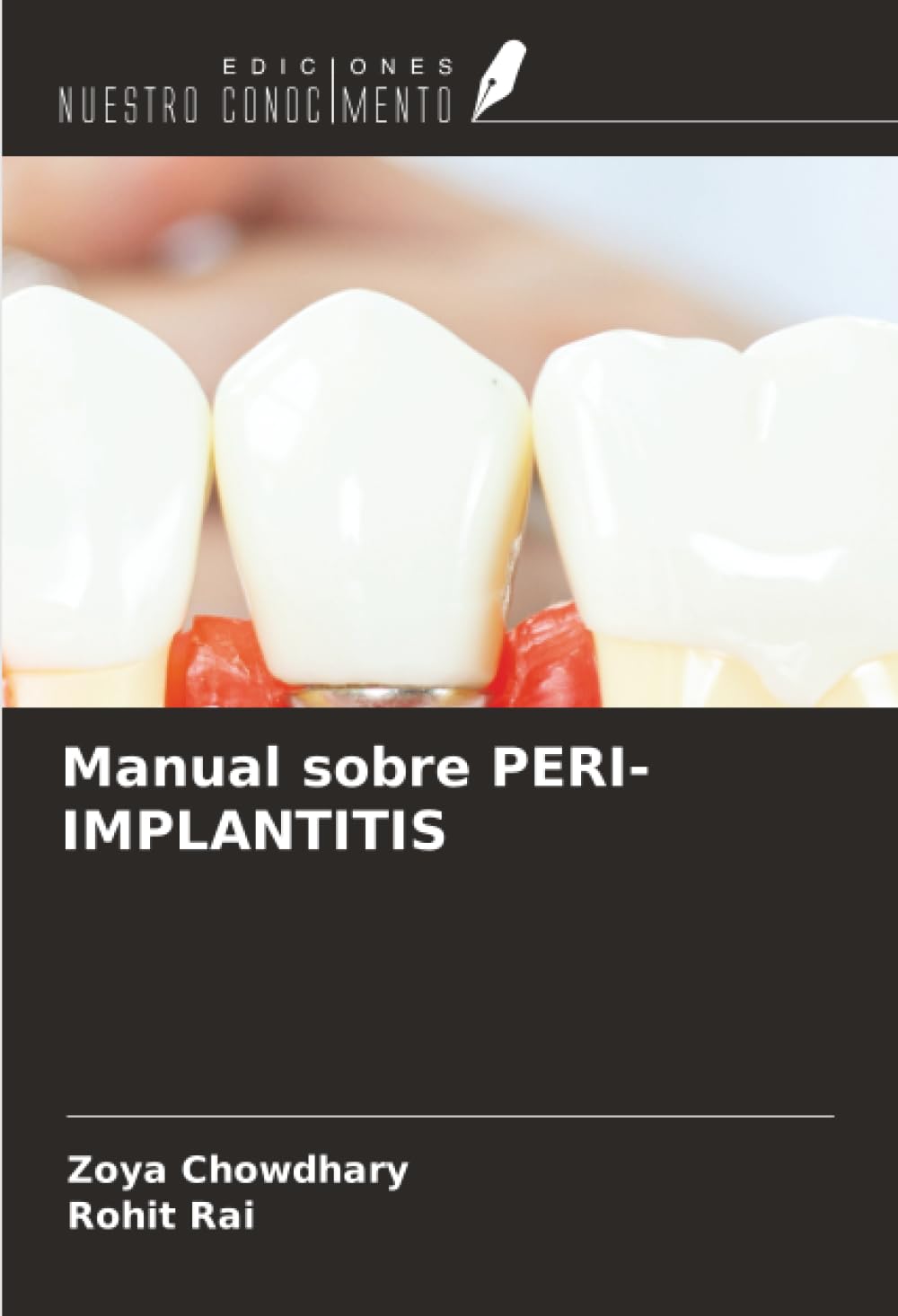 Manual sobre PERI-IMPLANTITIS