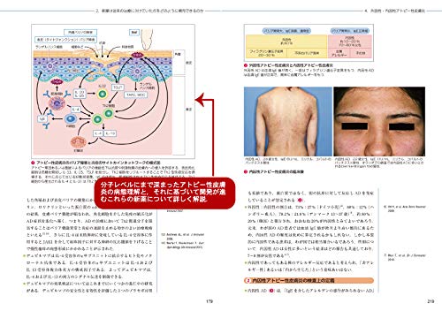中等症以上のアトピー性皮膚炎がabrocitinibで改善 デルマニアのブログ