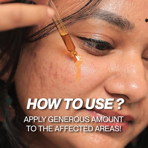 Image of Acne Oil 50 ML | Controls Acne & Sebum Secretion | For Oily Skin | Natural Anti-Inflammatory | Helps Removing Scar & Skin Tone | 100% Plant Based | For Men & Women