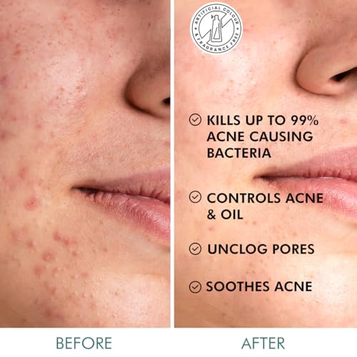 mCaffeine 2% Salicylic Acid Zinc PCA & Matcha Tea Clear Skin Acne Pads | Anti Acne Exfoliating Serum Toner Pads for Acne-Prone Skin | Unclogs... - Image 3