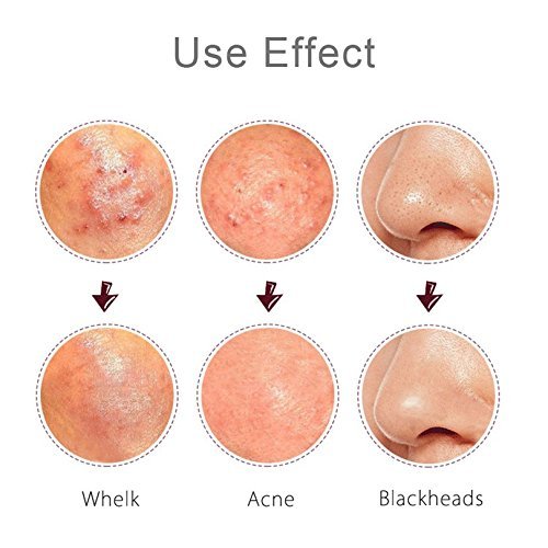 5PCS Blackhead Remover Tool kit, Kocopa Blackhead