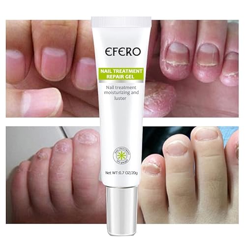 5 Pcs Efero Nail Repair Essence Gel,Nail Repair Cream,Toe Be Health Instant Beauty Gel For Nail Growth Care,Restores Appearance Of Discolored Or Damaged Nails #TOP6