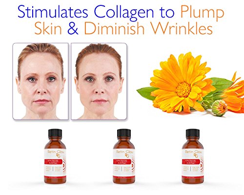 Glyco-Lactic Acid 60% Gel Peel Including After Peel Neutralizer Facial Peel Contains Glycolic Acid Retinol Vitamin C Kojic Acid Licorice Bearberry Tea Mulberry. Perfect Mild Strength Chemical Peel - Thumbnail 7
