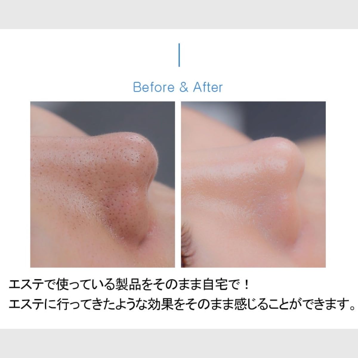 Medipeel Extra Super 9 Plus 2.0 250 ml - Blackhead Care Solution - Image 3