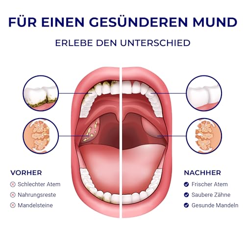 Oravix Munddusche Mandelsteine Entfernen, Munddusche Kabellos, Tonsillenstein Entferner, Reisemunddusche, Mobile Munddusche Nicht Elektrisch, Zahndusche, Irrigator Zähne, Oral Munddusche Kinder – Bild 8