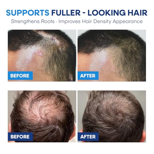 Image of Medicated Shampoo for Scalp Seborrheic Dermatitis & Psoriasis: Plant-Based Formula Soothes Itch, Reduces Flakes, Supports Hair Health & Deep Cleansing Treatment for man and women 300ml /10.0fl oz