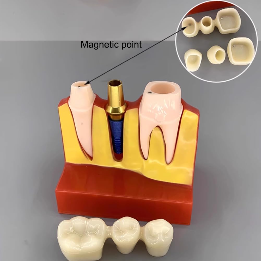 Modèle D'implant Dentaire - Modèle De Dent De Démonstration Pour Couronne Bridge Amovibles (4 Fois) - Modèle De Dent Pour L'analyse D'implants Dentaires À Des Fins D'apprentissage De Formation