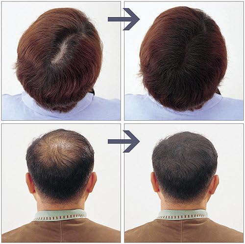 Amazon ヘアフォロー ブラウン アイメディア Aimedia 増毛 ボリュームアップスプレー 通販