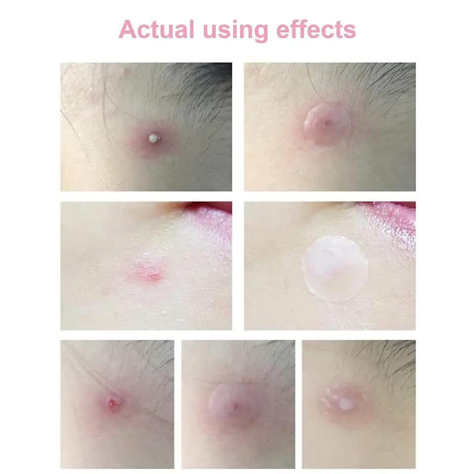 Xeerabdi Pimple Patch for Acne & Skin Tag Remover | Invisible Hydrocolloid Dots for Face | Acne & Tag Treatment for Women, Girls | Skin Tag Cover Patches (36 Pcs) (5) 4