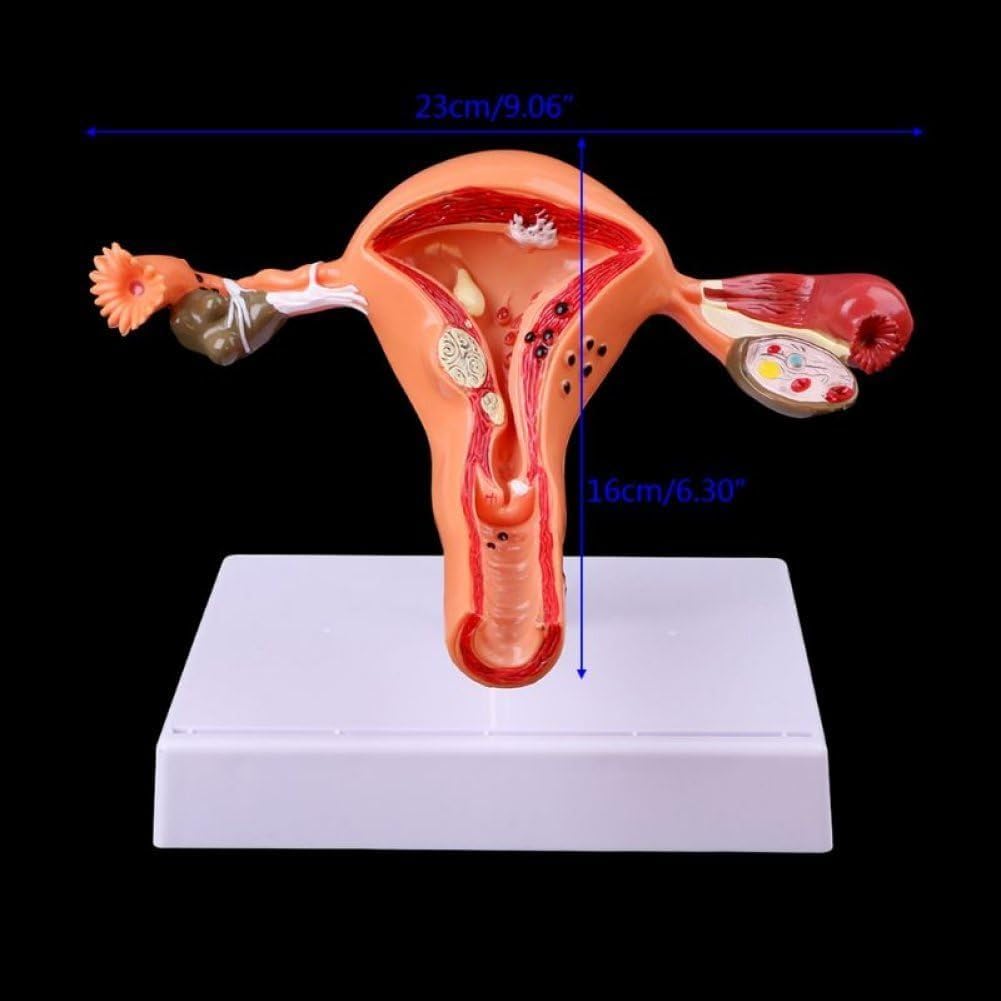 Modèle d'utérus et d'ovaire Grandeur Nature Modèle Anatomique d'utérus et d'ovaire pathologique Modèle Anatomique pour étude en Coupe Outil pédagogique Modèle de matériel médical