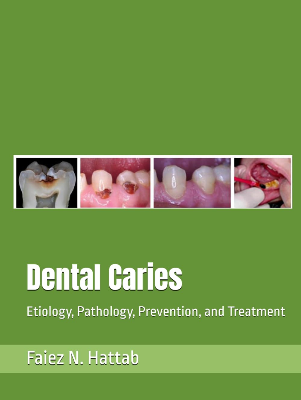 Dental Caries: Etiology, Pathology, Prevention, and Treatment