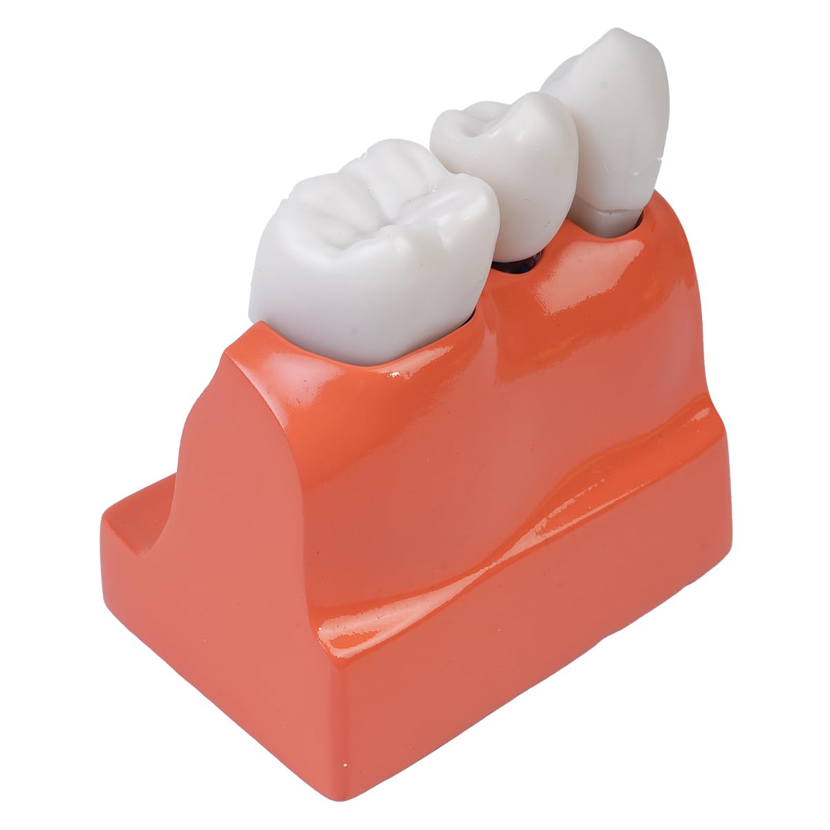 Sarini Modelo de Diente Oral, Modelo de implante Dental con Corona y Puente extraíbles para demostración y formación