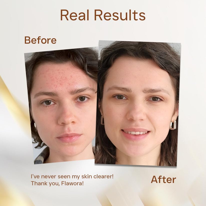 Generic Anti Acne Face Serum 30ml (Pack of 2) | Lightweight Skin Care Formula for Daily Use