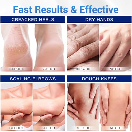 Urea Cream 40 Percent for Feet, Urea Cream, Urea Foot, Foot Cream, Foot Cream with Hyaluronic Acid for Feet, Hands, Heels, Elbows, Nails and Knees, 150g - Image 4