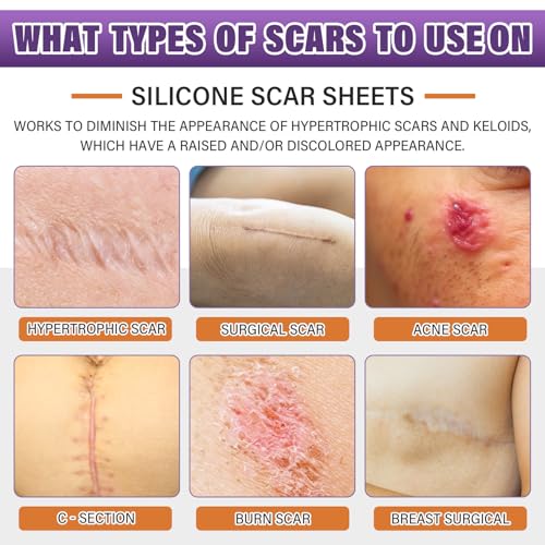 Image of Silicone Scar Sheets, Medical Grade Silicone Scar Tape for Surgical, Hypertrophic, Keloid, C-Section, Burn, Old & New Scars, Reusable Professional Scars Removal Sheets (1.6 inchX 157 inch Roll-4M)