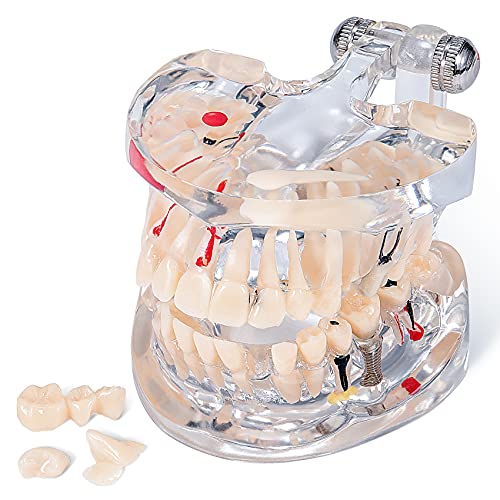 Annhua Transparent Tooth Model Dental Disease Implant Teeth Model Removable, Dentist Standard Tooth Pathological Demonstration - Teaching Learning Tool for Dentists, Patients, Teachers and Students
