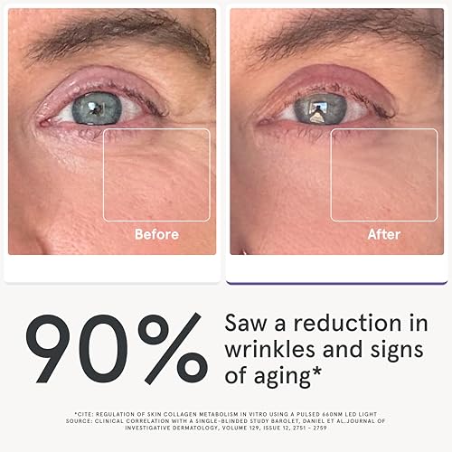 Image of iRestore Red Light Therapy for Eyes - 180 LEDs Eye Mask with Infrared Light for Under-Eye Wrinkles, Forehead Lines, 11's, Crow's Feet, Dark Circles