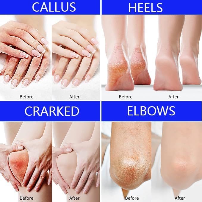 Urea Cream 40 Percent Foot Cream, Cracked Heel Repair & Callus Remover for Dry Hard Skin, Deep Moisturizing Foot Moisturiser - Image 2