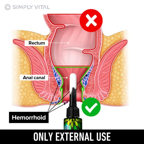 Hemorrhoid Treatment Cream Gel For Pain Relief - Made In Usa Fast Acting Piles Remover 5% Lidocaine For Pain, Itching & Swelling Relief - Drug Medication Ointment To Shrink Hemorrhoids & Heal Fissures #TOP3
