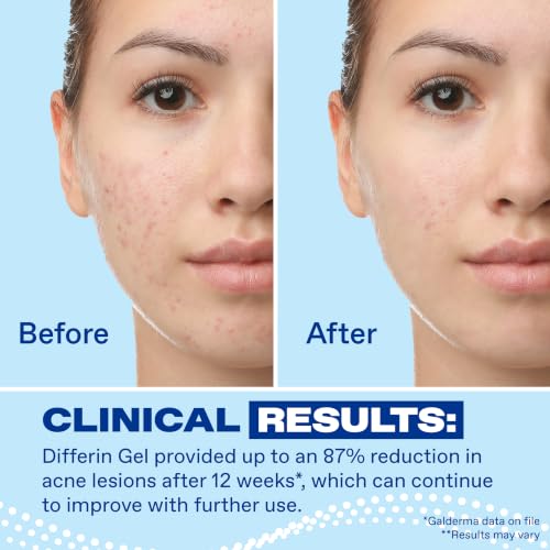Image of Differin Acne Treatment Gel, 90 Day Supply, Retinoid Treatment for Face with 0.1% Adapalene, Gentle Skin Care for Acne Prone Sensitive Skin, 45g Pump (Packaging May Vary)