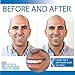 Instant Smile Temporary Tooth Kit -Pro-Series