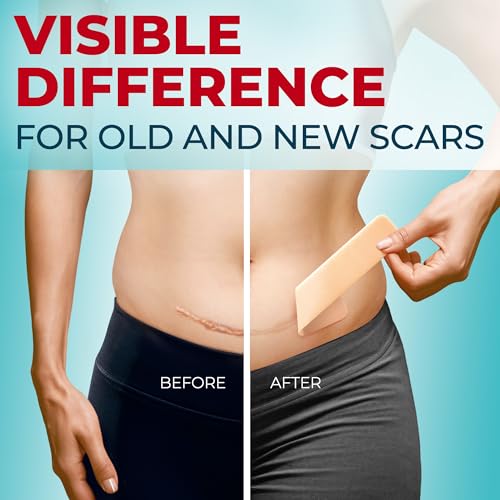 medical grade silicone scar tape - 16x150 - visible difference on keloid amp -section - reusable silicone scar sheets - easy to use