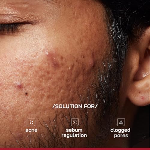 Image of /PHD / 2% Salicylic Acid Anti-Acne Serum | Salicylic Acid Face Serum for Acne-Prone & Oily Skin | Pore Minimizing serum with Niacinamide & Peptides |Reduces Blackheads & Excess Oil | Men & Women I30 ml