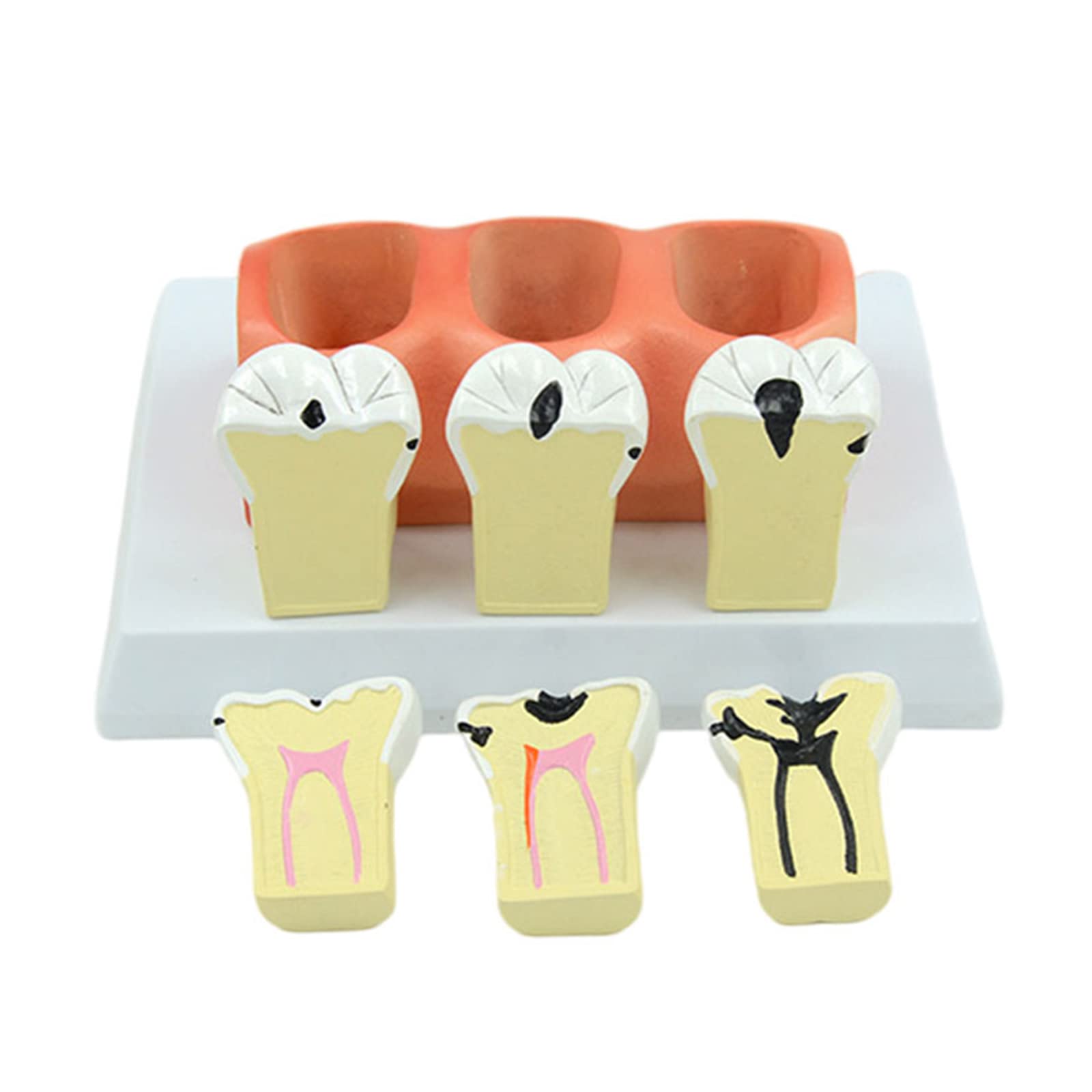 KJMWXOP Anatomical Tooth Model, Removable Anatomical Model Of Caries Decomposition, Visual Tool For The Pathological Evolution Of Caries