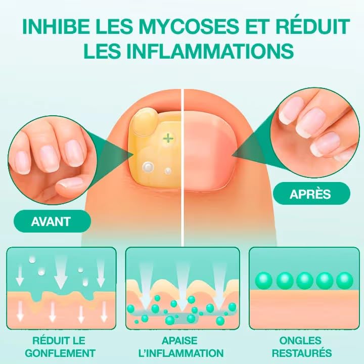 Patch Antifongique Ongle Dermisya Amélioration Visible et Application Nuit - 2