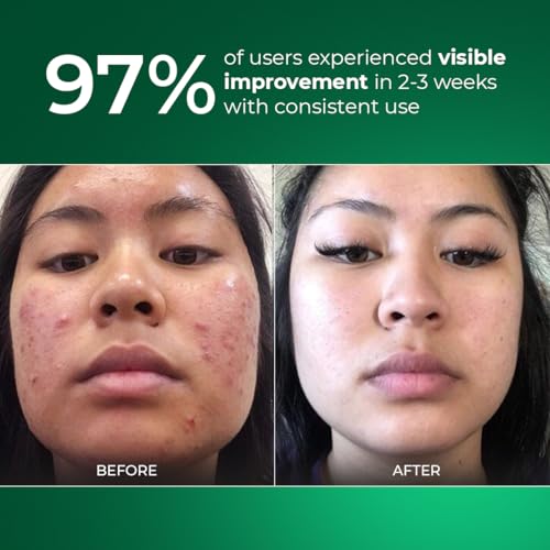 Image of Aqueria Oil Control Brightening Gel Multi-Active French Sunscreen SPF 50 PA++++ | In-Vivo /In-Vitro Tested | 2% Niacinamide, BHA & Hyaluronic Acid | Modern UV Filters | Broad Spectrum UVA /UVB & Blue Light Protection | Lightweight, Non-Greasy, No White Cast | Suitable for Daily Use | For Oily, Acne-Prone & Combination Skin | 100g
